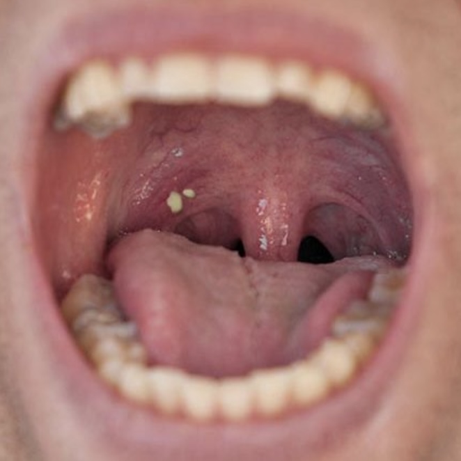 As bolinhas brancas na garganta, também chamados de cáseos ou