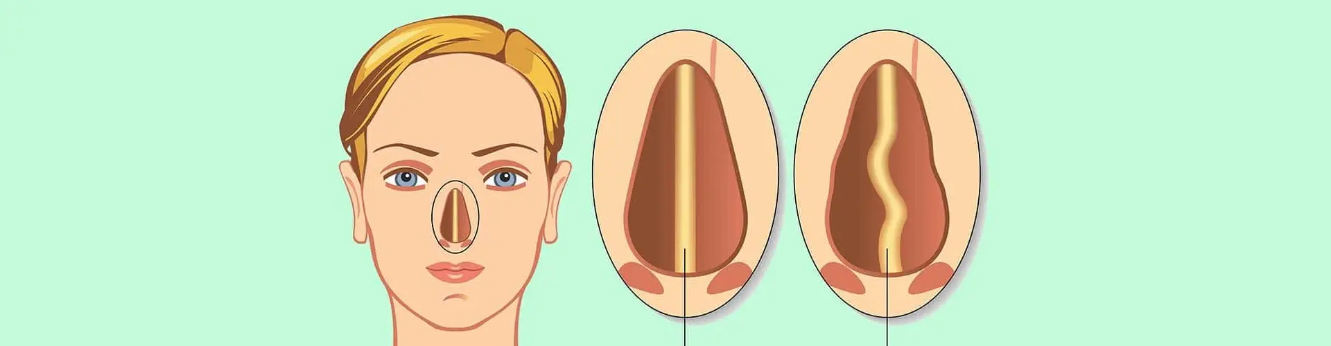 Cirurgia de desvio de septo