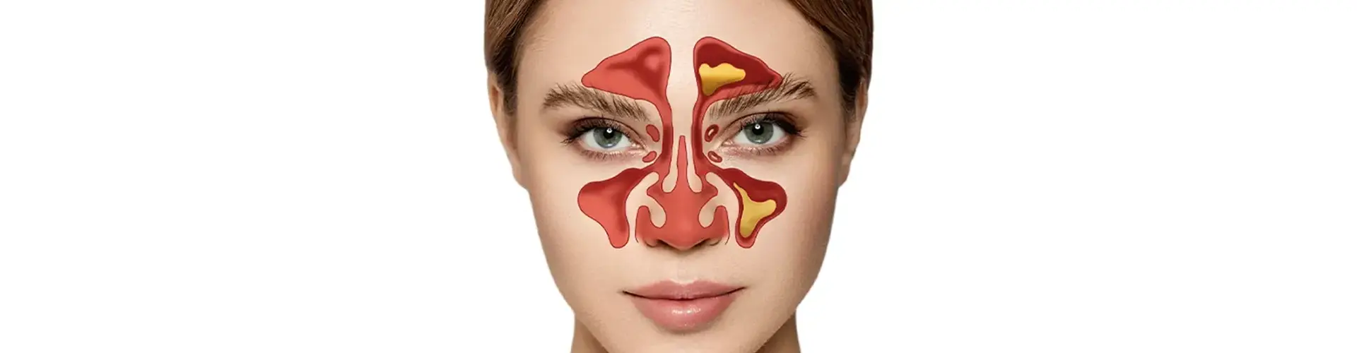 Cirurgia para Sinusite Crônica (FESS)